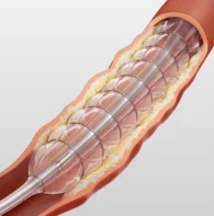 Kateter tal-Bużżieqa Nitinol PTA
